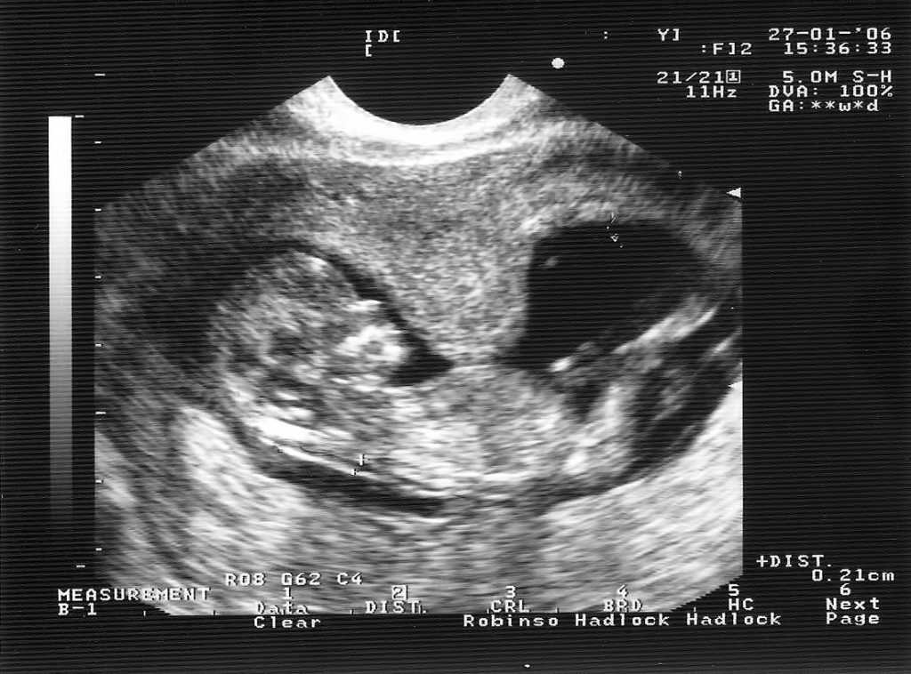 Тонус матки при беременности в 3 семестре