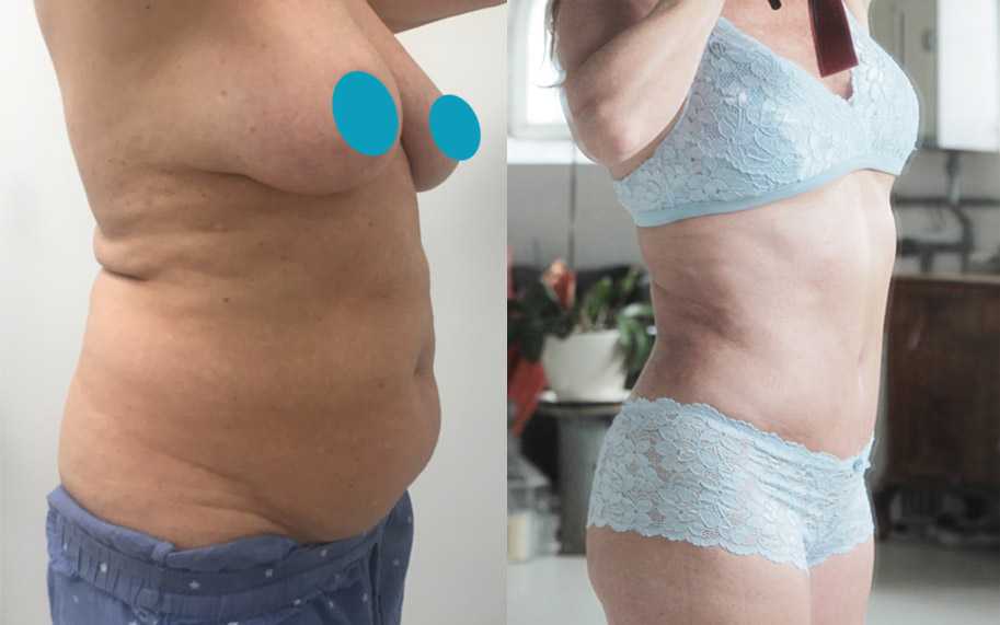 Грудь после родов, как подтянуть и восстановить форму груди после прекращения кормления, пластика сосков и коррекция