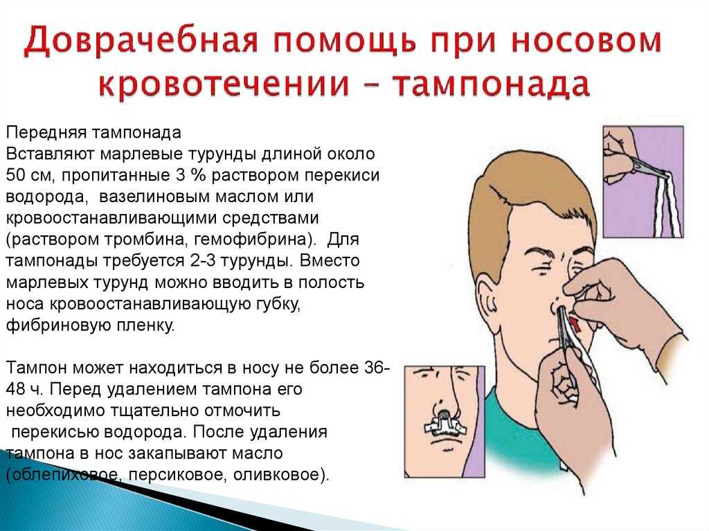 Частые носовые кровотечения у взрослых
