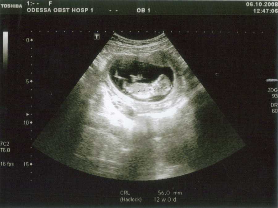 Снимок узи 2 недели беременности фото