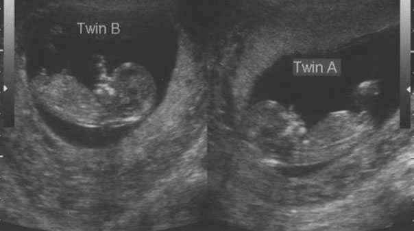 Как забеременеть двойней или близнецами естественным путем — ответы гинеколога