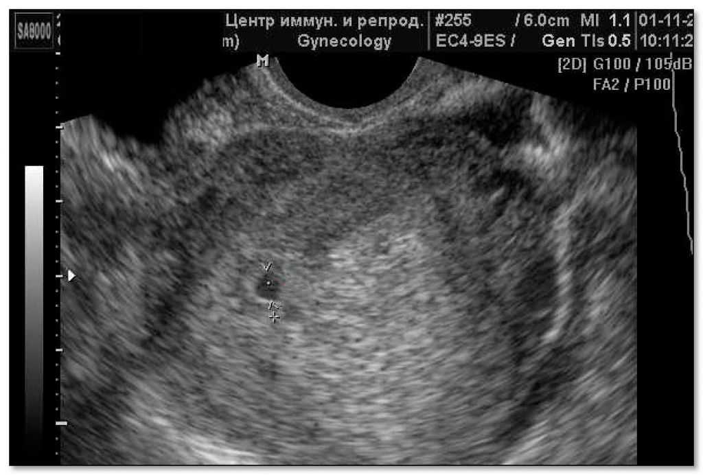 Узи на ранних сроках беременности (до 11 недель) в минске - 36и6