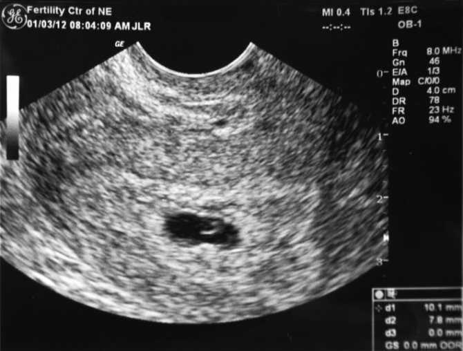 Срок беременности 3 недели — признаки, симптомы и ощущения