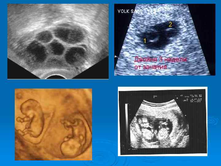 Узнайте все самое важное о 3й неделе беременности двойней на нашем сайте Что происходит в организме женщины, что видно на УЗИ, какие ощущения сопровождают беременную