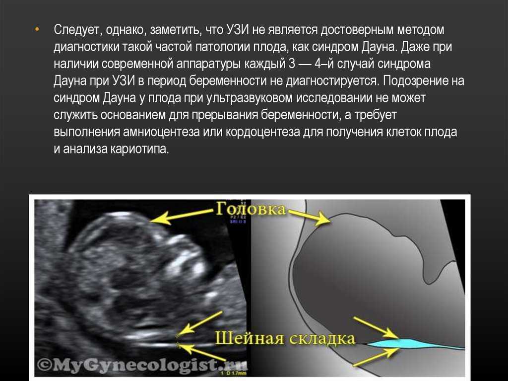 Узнайте все самое важное о 5й неделе беременности двойней на нашем сайте Что происходит в организме женщины, что видно на УЗИ, какие ощущения сопровождают беременную