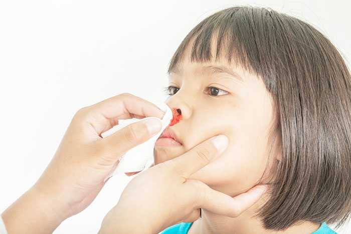 Лечение частых носовых кровотечений