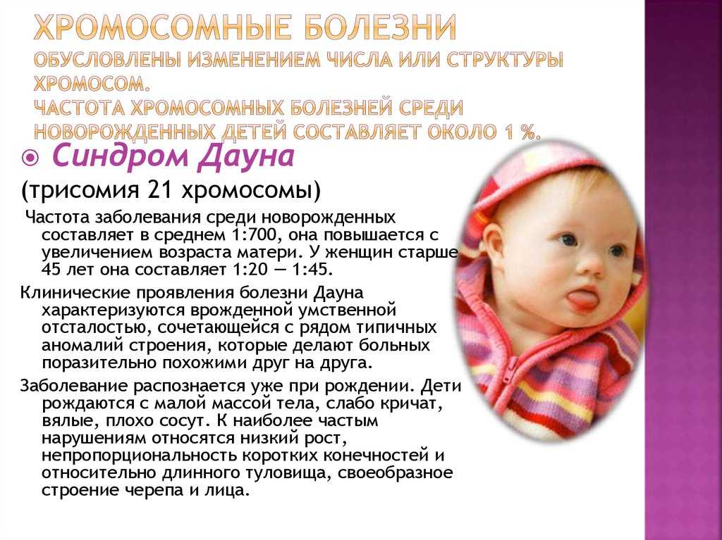 Признаки синдрома дауна малыша: в утробе и после рождения