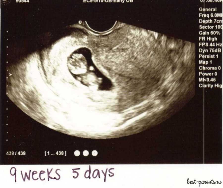 Узи на 9 неделе беременности: фото плода, показатели, нормы
