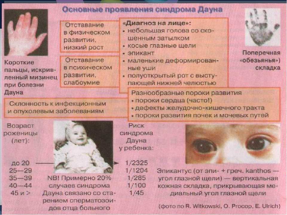 Причины и признаки синдрома дауна - диагностика у плода при беременности, развитие ребенка и меры профилактики