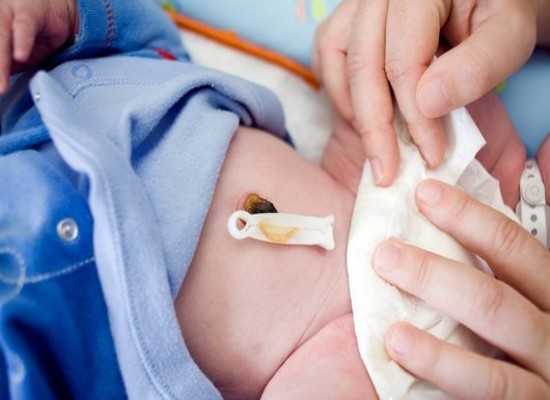 Обработка пуповины новорожденного: как обработать пупок при наличии прищепки, обработка после того, как отпала, первичная обработка пуповины