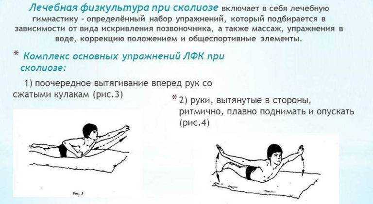 Лфк при сколиозе: упражнения, подходящие для детей