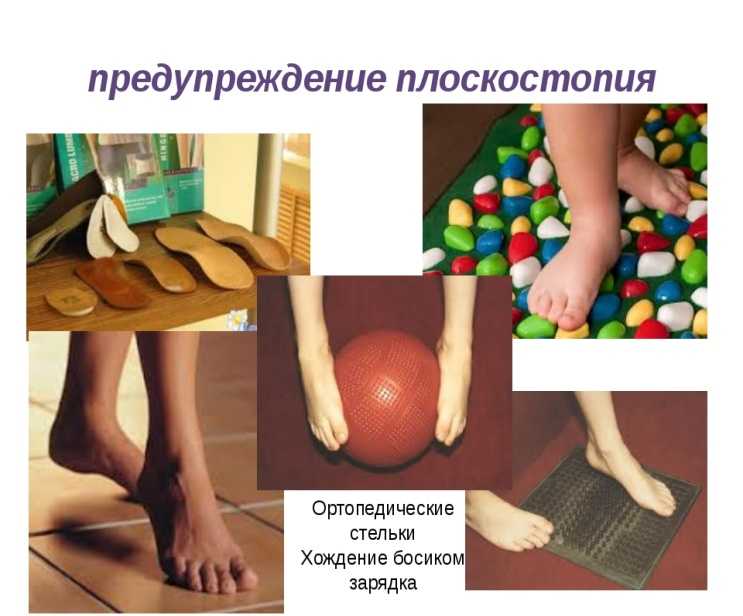 Массаж при плоскостопии у детей + видео | prof-medstail.ru